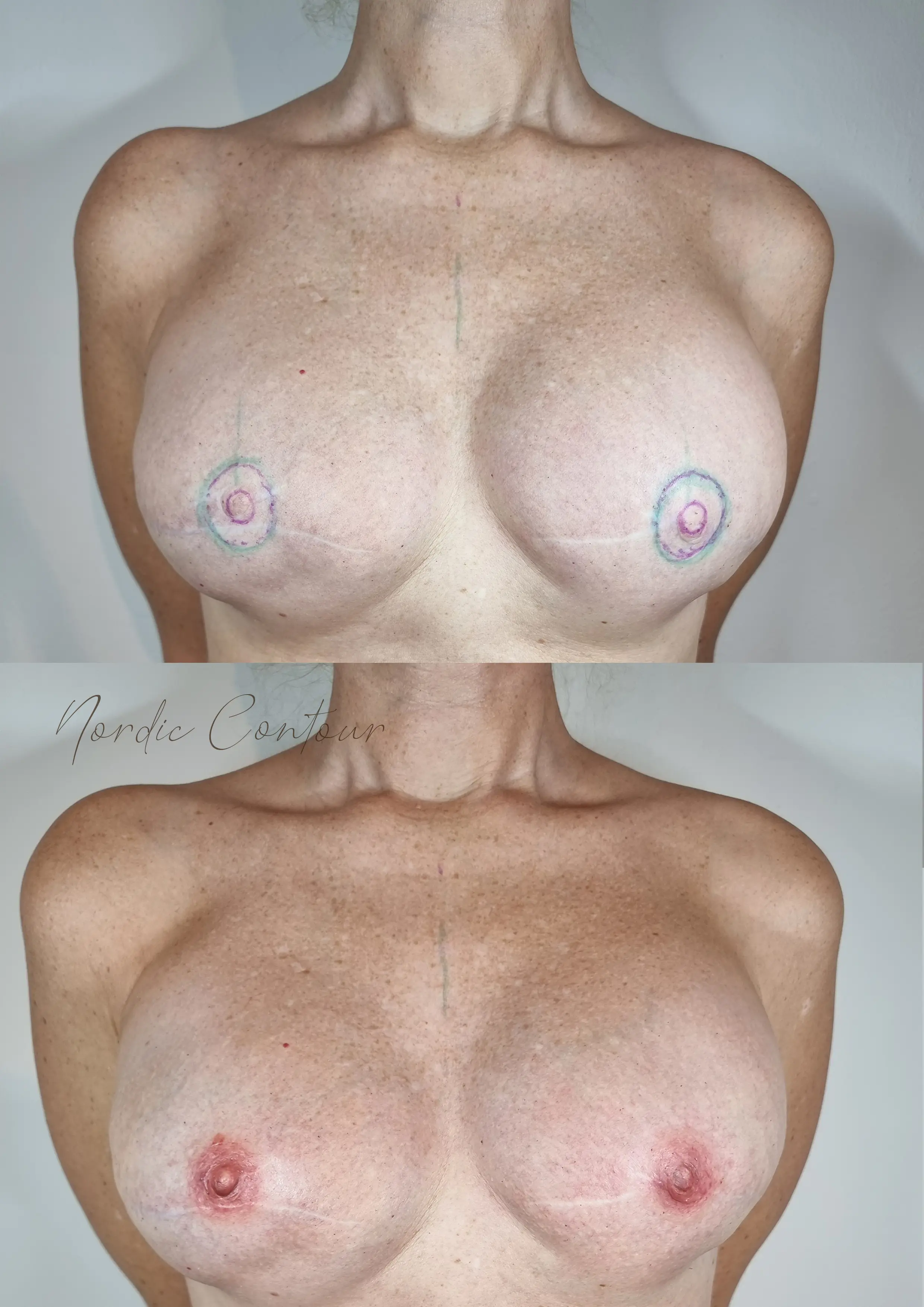 Før behandling: Areola-rekonstruktion (3D). 3D-pigmentering der genskaber brystvorte og areola visuelt efter operation. Træk i slideren for at se før og efter.